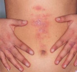 scabies
